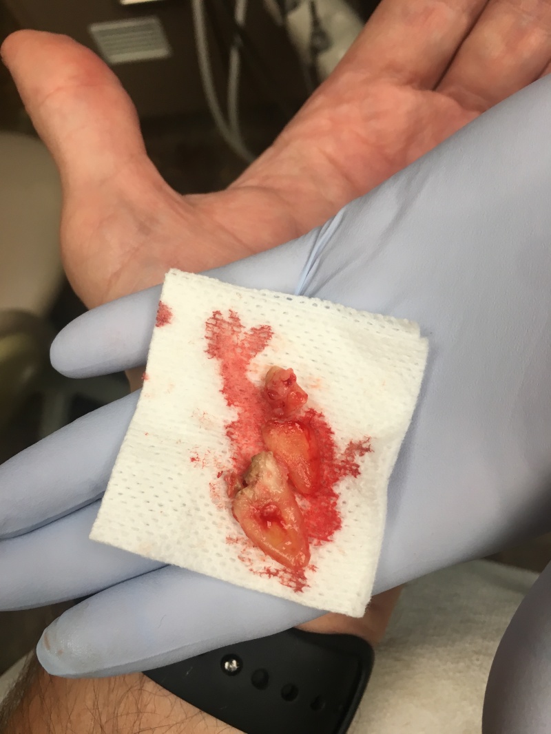 2019/09(September)/Broken-Tooth/800x600_2019-09-16-Broken-crown-2.JPG