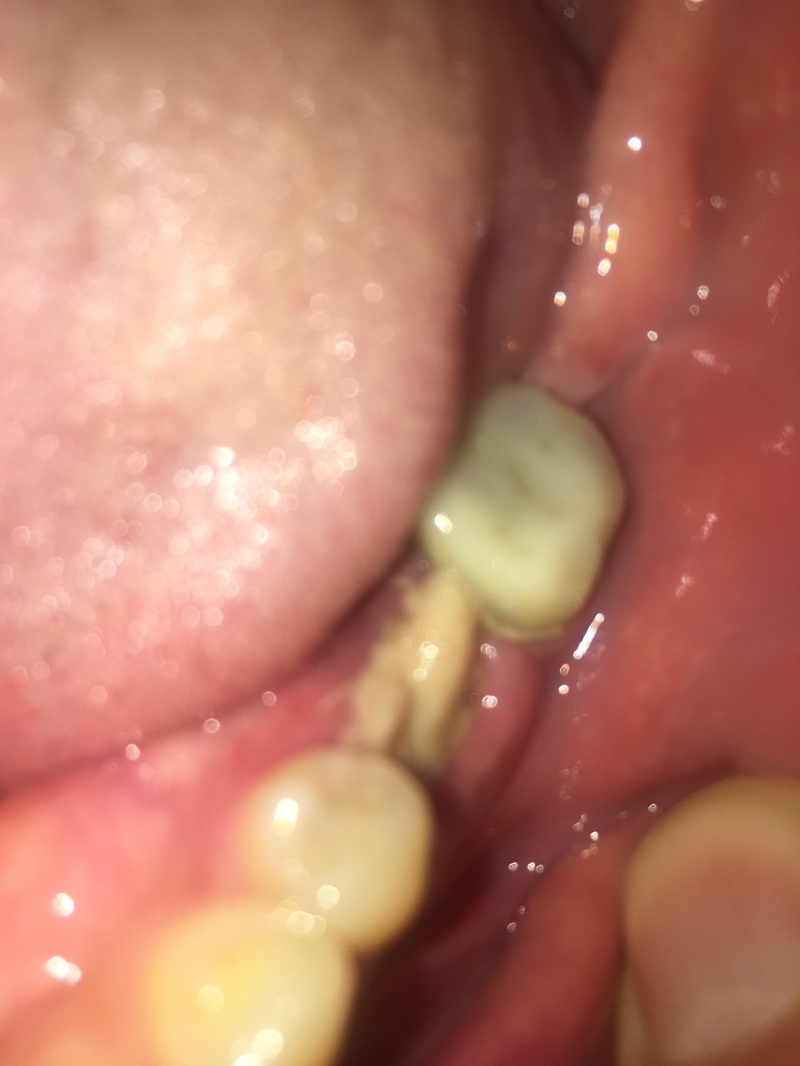 2019/09(September)/Broken-Tooth/800x600_2019-09-19-Broken-crown-2.JPG