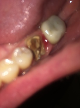 2019-08-20-Broken-crown-5.JPG