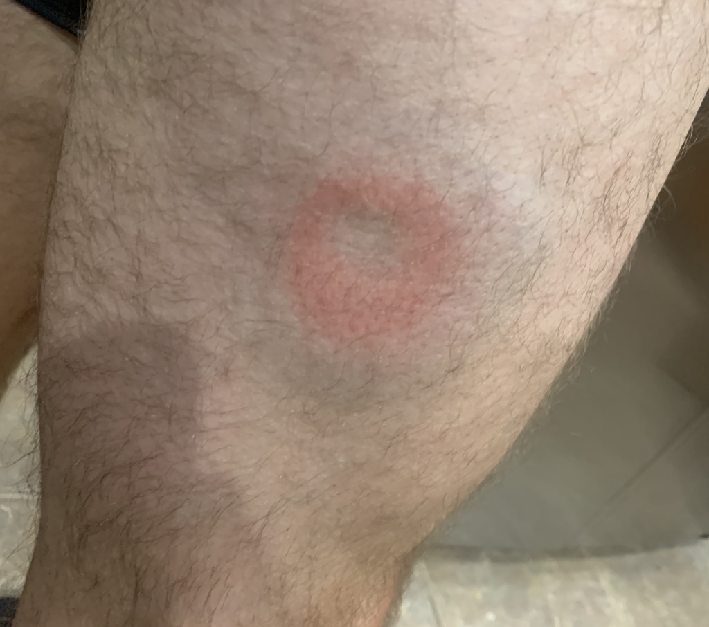 2019/12(December)/Misc/1024x768_2019-12-06-Racquetball-bruise.JPG