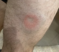2019/12(December)/Misc/2019-12-06-Racquetball-bruise.JPG