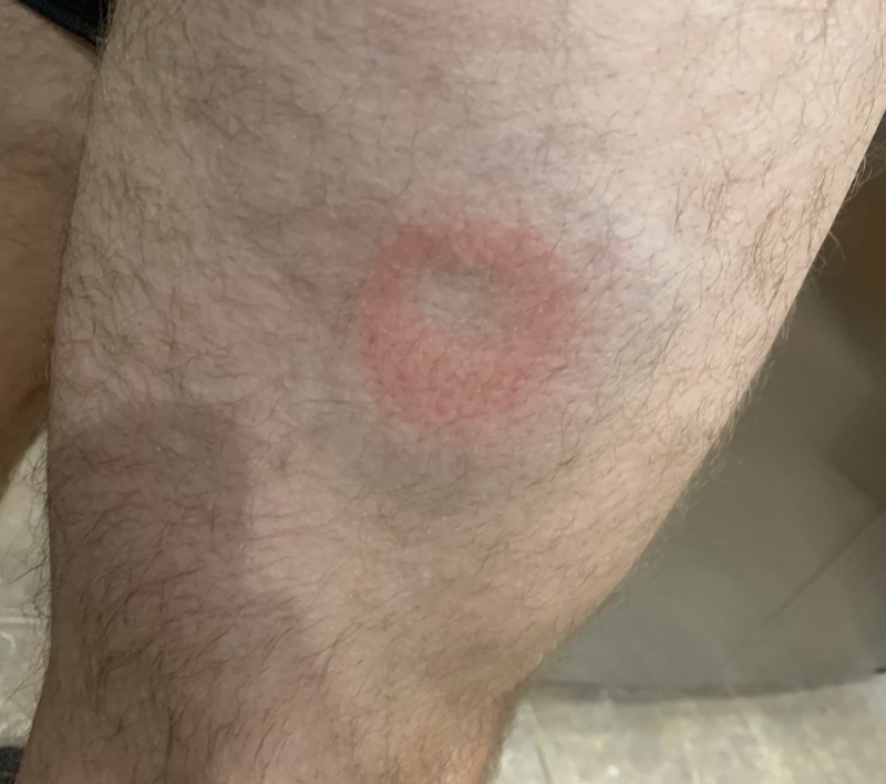 2019/12(December)/Misc/800x600_2019-12-06-Racquetball-bruise.JPG