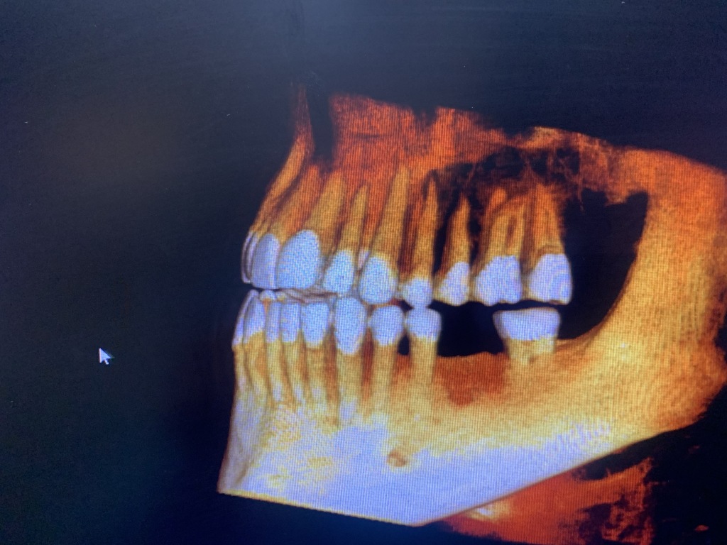 2020-01-22-Travis-Dental-implant-3-Xrays.JPG