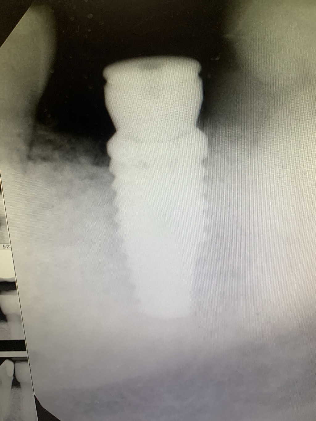 2020/01(January)/Travis-Dental-implant/1024x768_2020-02-20-Travis-Dental-implant-Xray.JPG