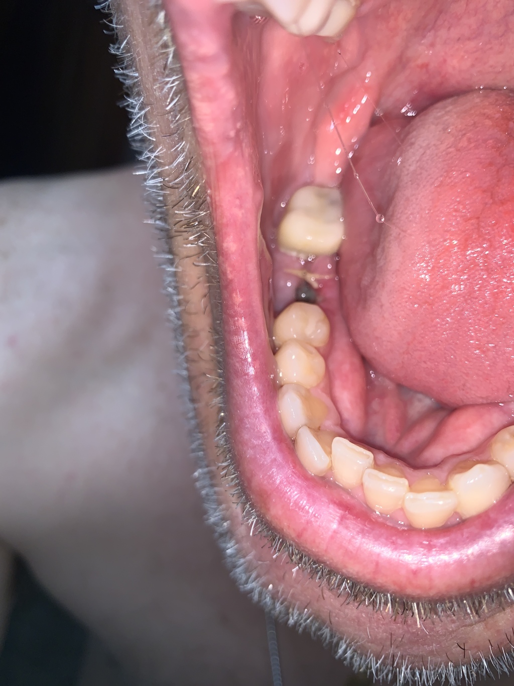 2020/01(January)/Travis-Dental-implant/1024x768_2020-09-22-Dental-Implant-started-on-right-lower-1.JPG