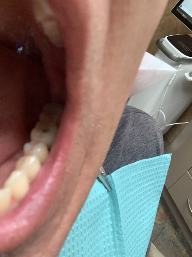 2020-09-15-Dental-implant-finished-on-left.JPG