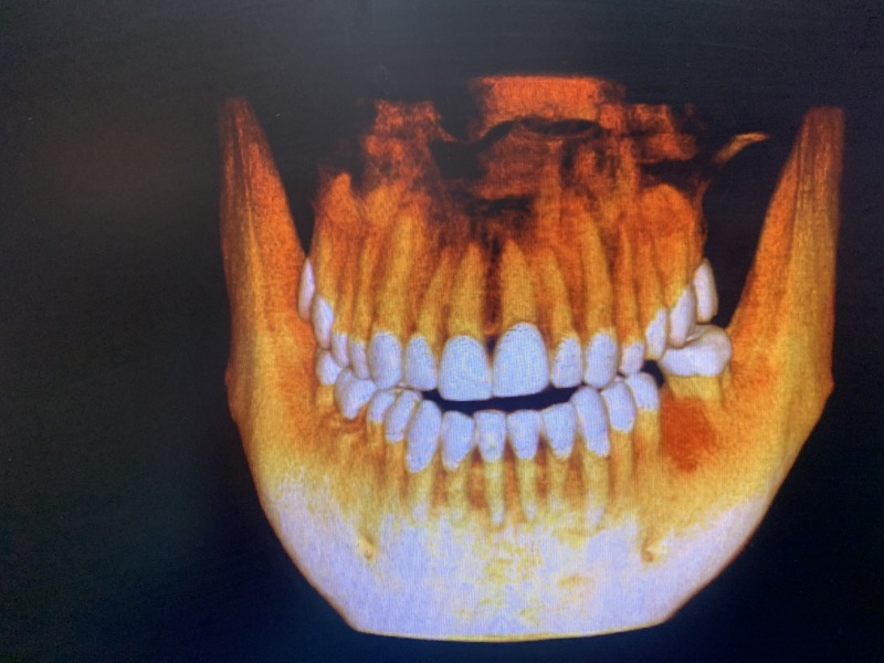 2020-01-22-Travis-Dental-implant-2-Xrays.JPG