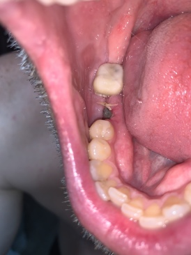 2020-09-22-Dental-Implant-started-on-right-lower-2.JPG