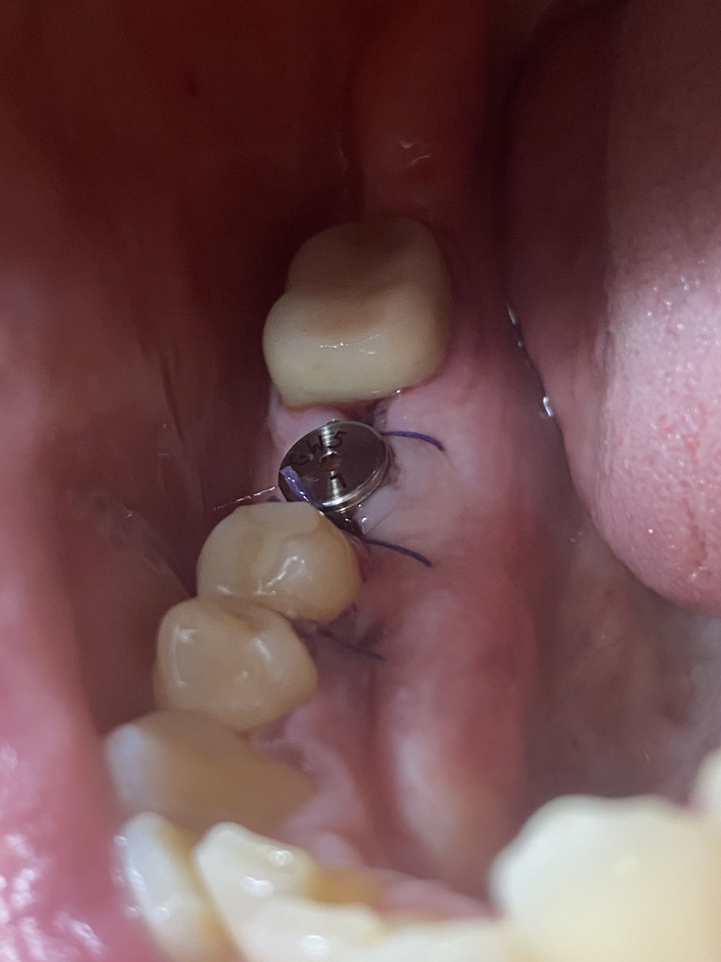 2021/01(January)/Dental-Implant/1024x768_2021-01-19-Dental-Implant-Travis-3.JPG