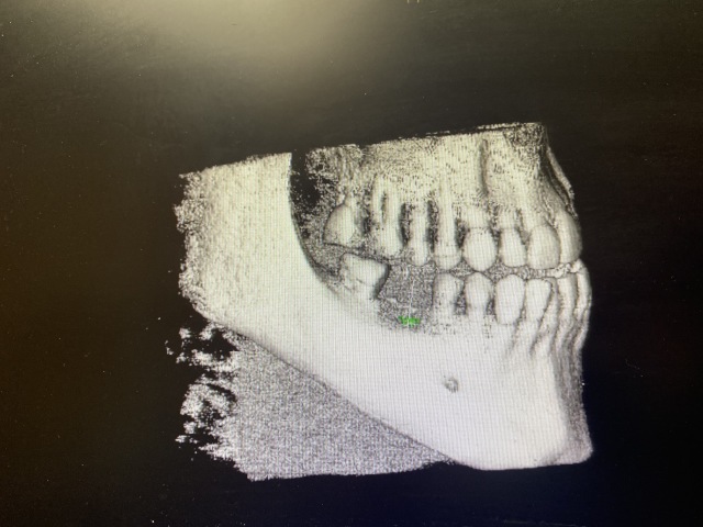 2021/01(January)/Dental-Implant/2021-01-19-Dental-Implant-Travis-1.JPG