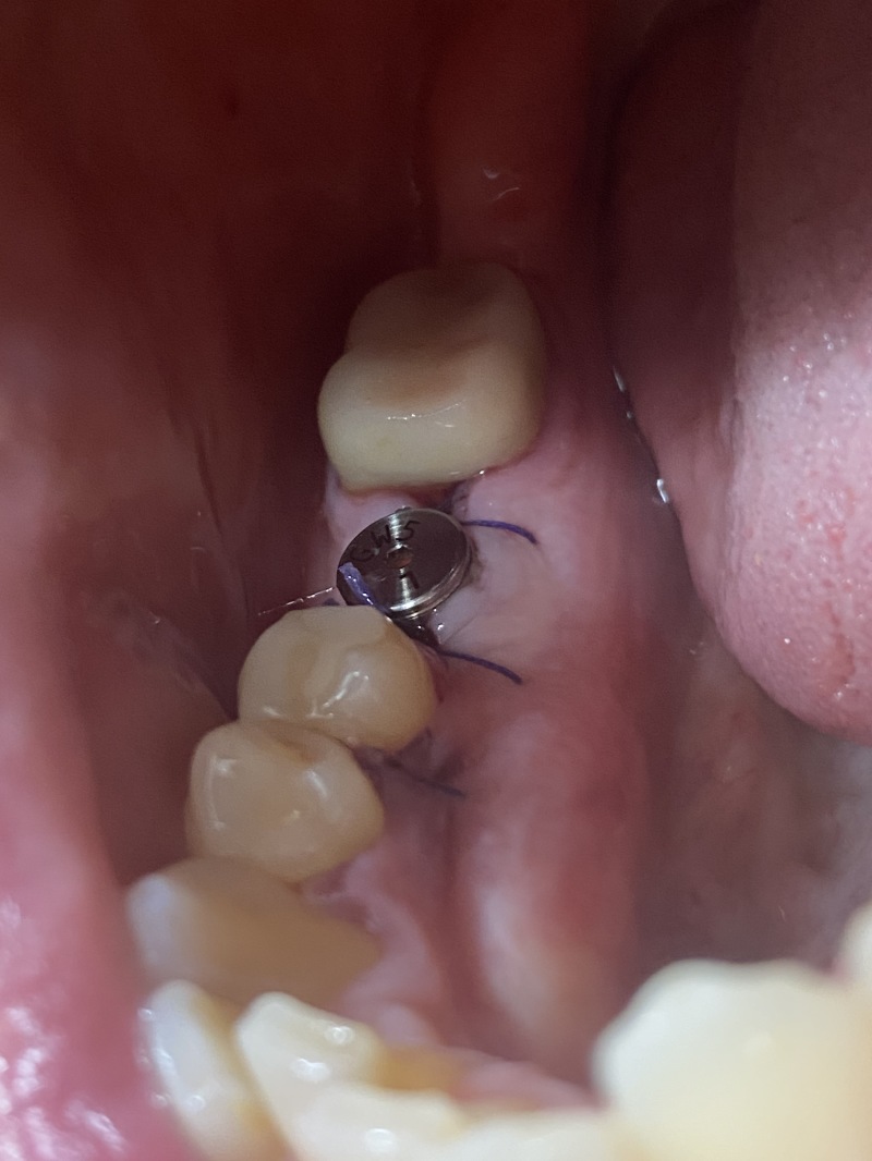 2021-01-19-Dental-Implant-Travis-3.JPG