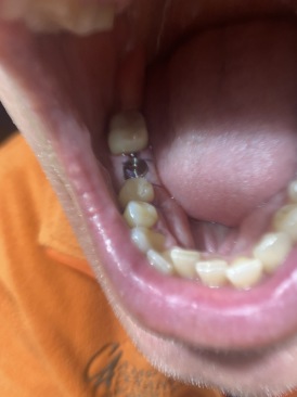 2021-01-19-Dental-Implant-Travis-2.JPG