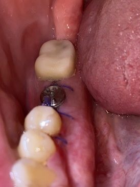 2021-01-25-Dental-Implant-Travis.JPG