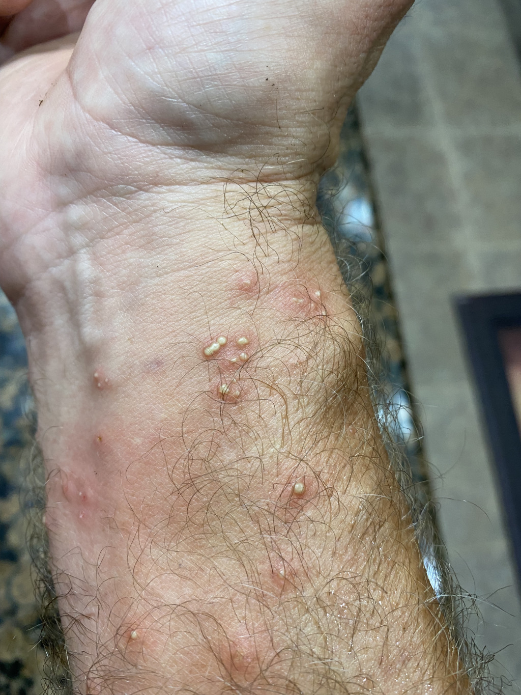 2021/08(August)/Hutto-tree-damage-from-freeze/1024x768_2021-08-09-Travis-Ant-bites-from-Palm-Tree-2.jpg