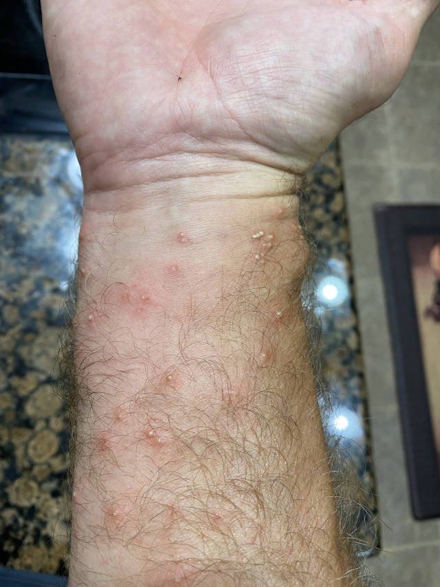 2021/08(August)/Hutto-tree-damage-from-freeze/640x480_2021-08-09-Travis-Ant-bites-from-Palm-Tree-1.jpg