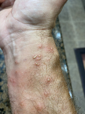 2021-08-09-Travis-Ant-bites-from-Palm-Tree-2.jpg