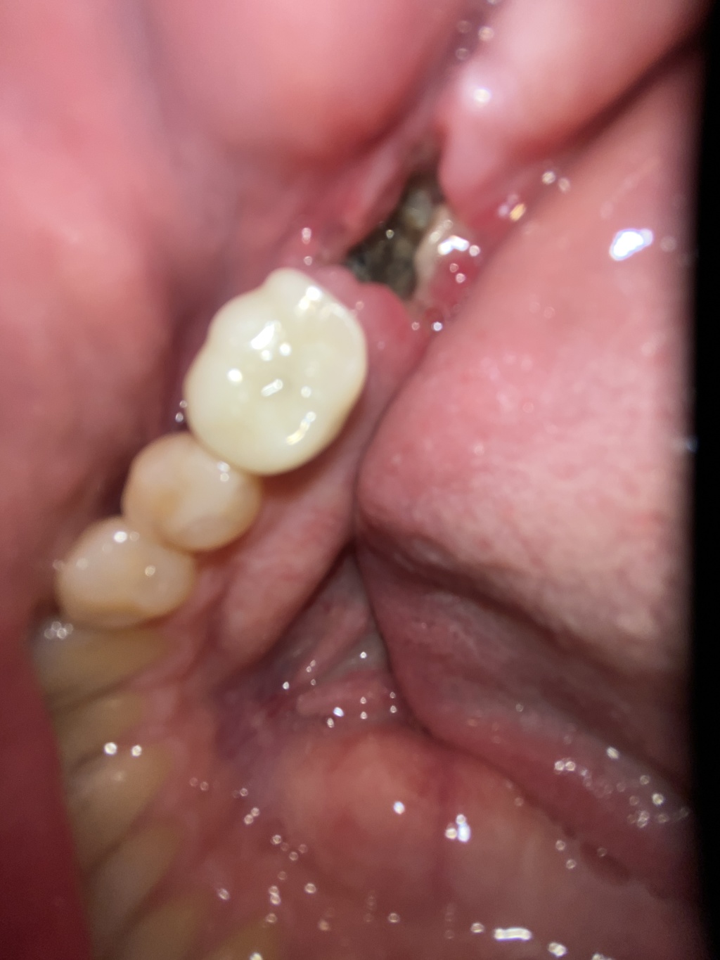 2022-01-13-Travis-Dental-Implant-3.JPG