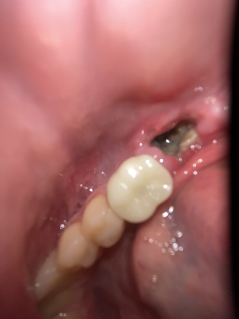 2022-01-13-Travis-Dental-Implant-4.JPG