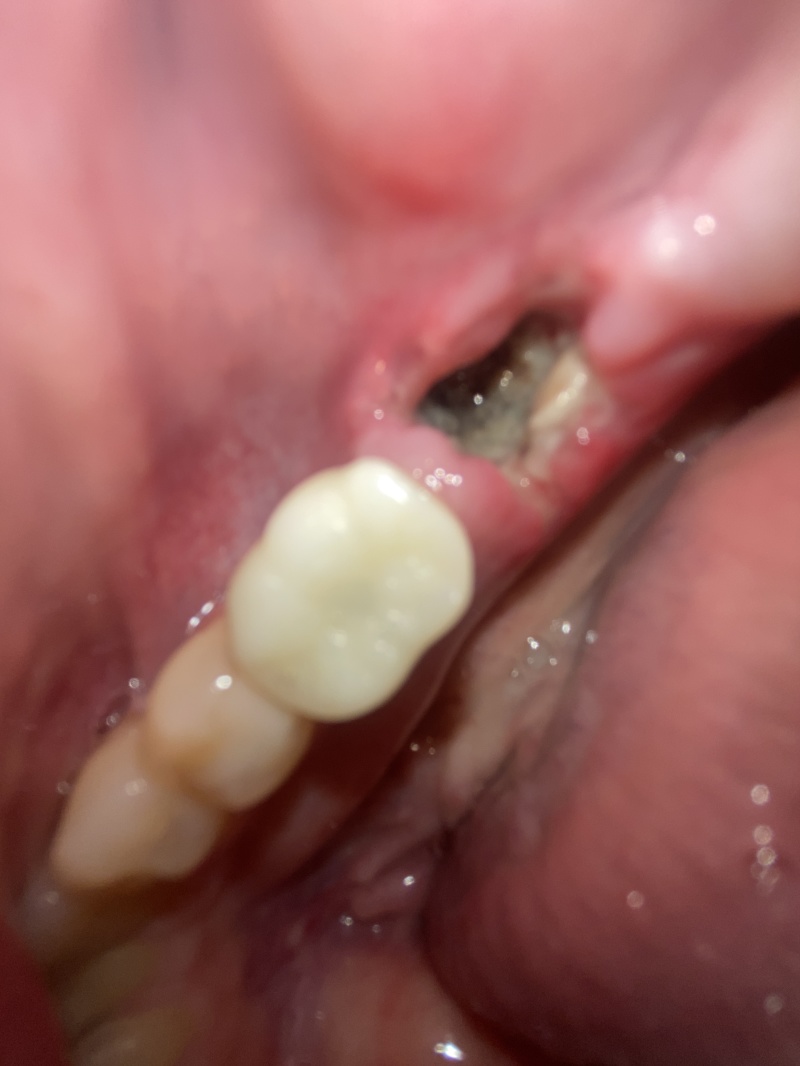 2022-01-13-Travis-Dental-Implant-5.JPG