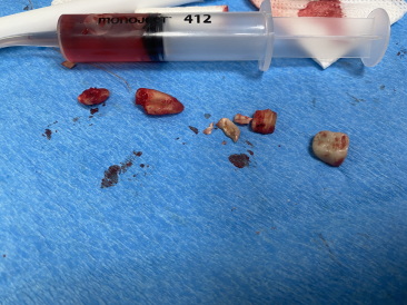 2022-01-05-Travis-Dental-Implant-2.JPG