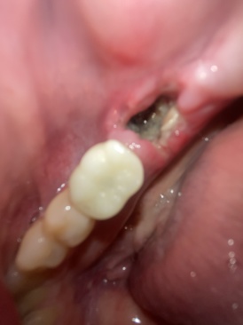 2022-01-13-Travis-Dental-Implant-5.JPG