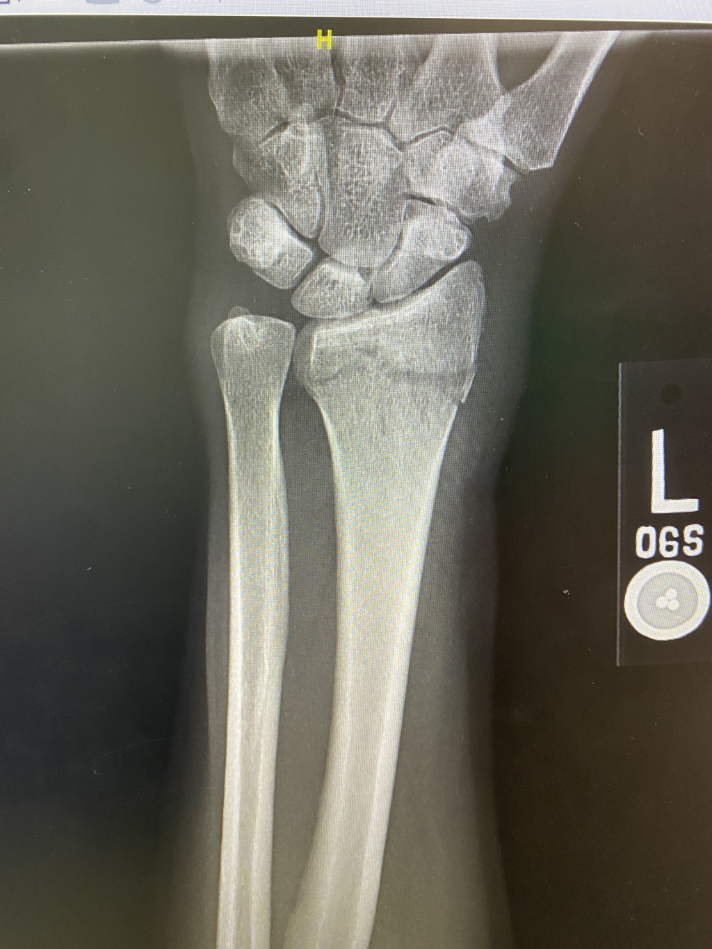 2022/06(June)/Suzi-Broken-Arm/1024x768_2022-06-12-Suzi-Broken-Arm-scraped-knee-04.JPG