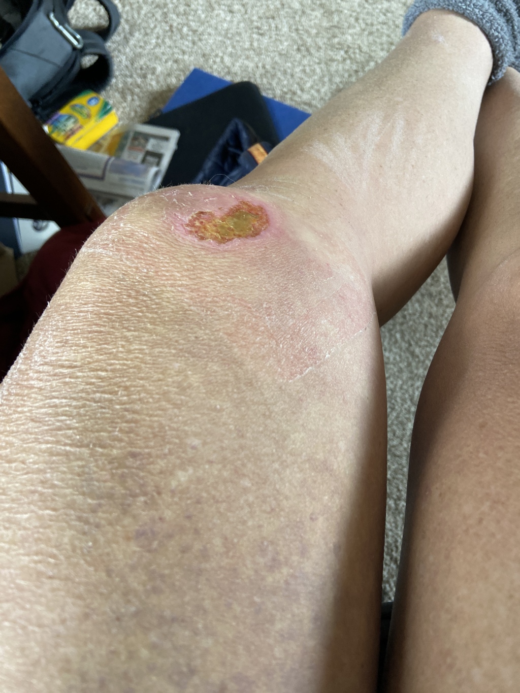 2022/06(June)/Suzi-Broken-Arm/1024x768_2022-06-23-Suzi-Broken-Arm-scraped-knee-17.JPG