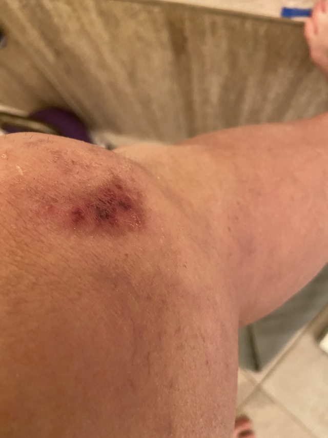2022/06(June)/Suzi-Broken-Arm/640x480_2022-09-05-Suzi-Broken-Arm-scraped-knee-25.JPG