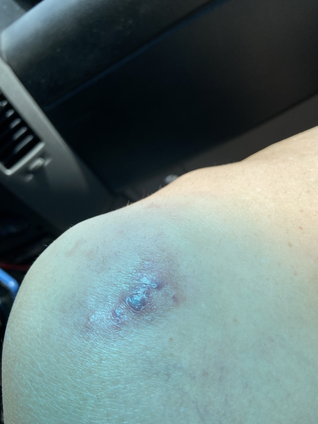2022/06(June)/Suzi-Broken-Arm/640x480_2022-09-08-Suzi-Broken-Arm-scraped-knee-26.JPG