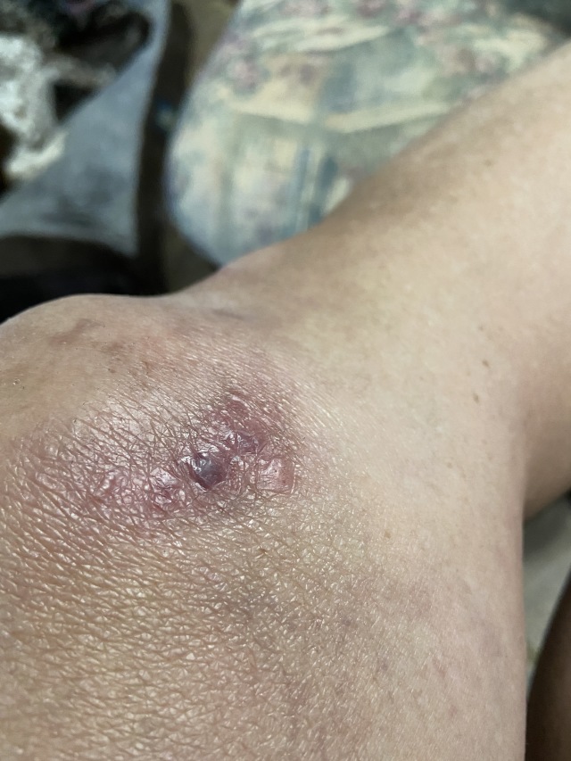 2022-09-11-Suzi-Broken-Arm-scraped-knee-27.JPG