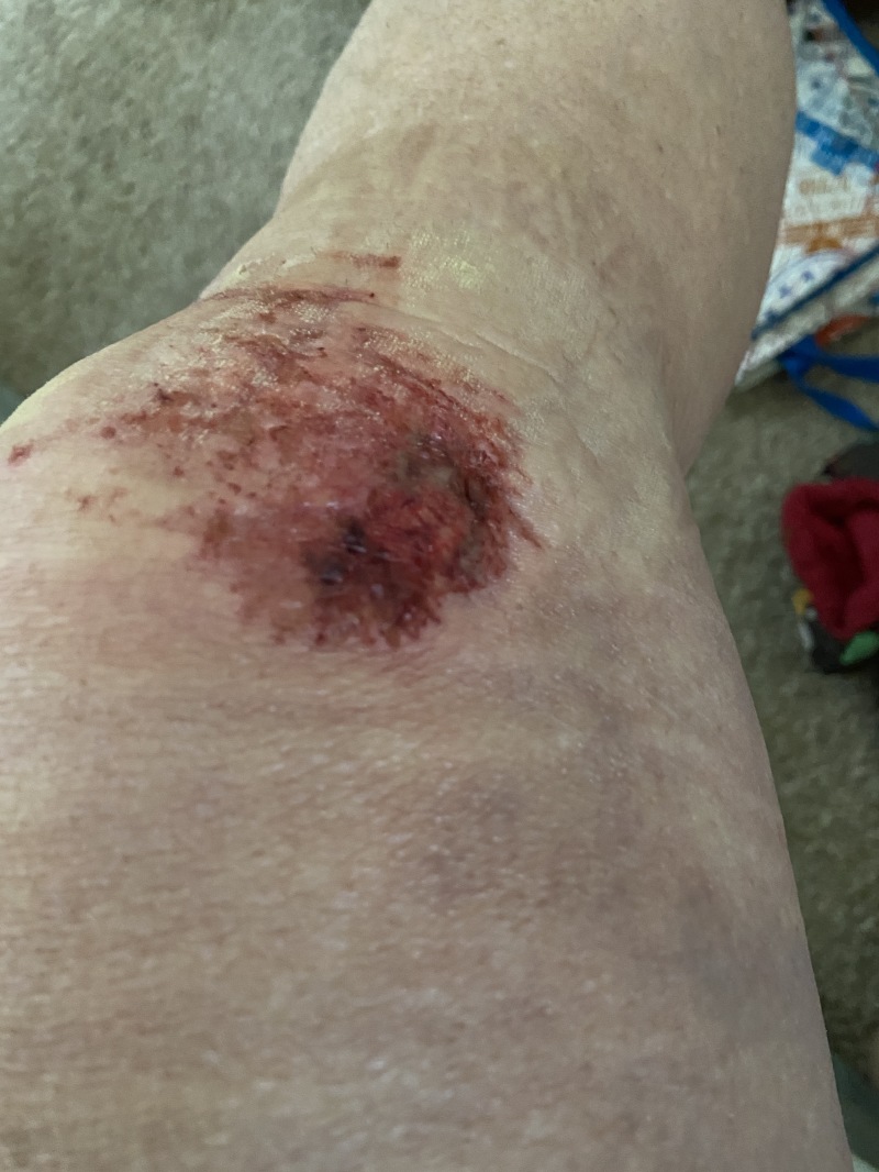 2022/06(June)/Suzi-Broken-Arm/800x600_2022-06-14-Suzi-Broken-Arm-scraped-knee-08.JPG