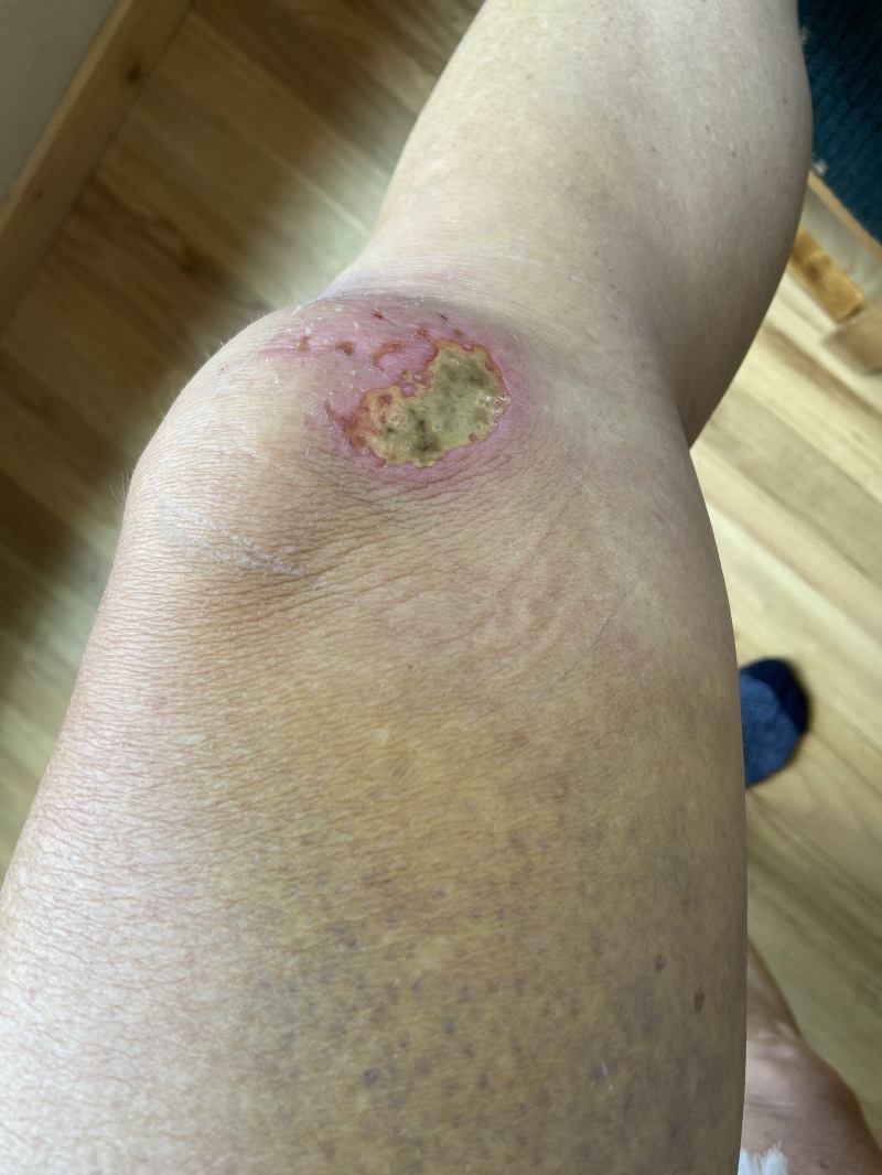 2022/06(June)/Suzi-Broken-Arm/800x600_2022-06-20-Suzi-Broken-Arm-scraped-knee-16.JPG