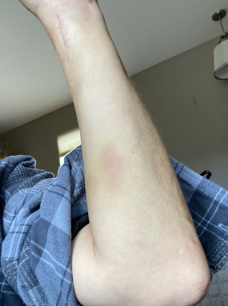 2022-07-06-Suzi-Broken-Arm-scraped-knee-22.JPG