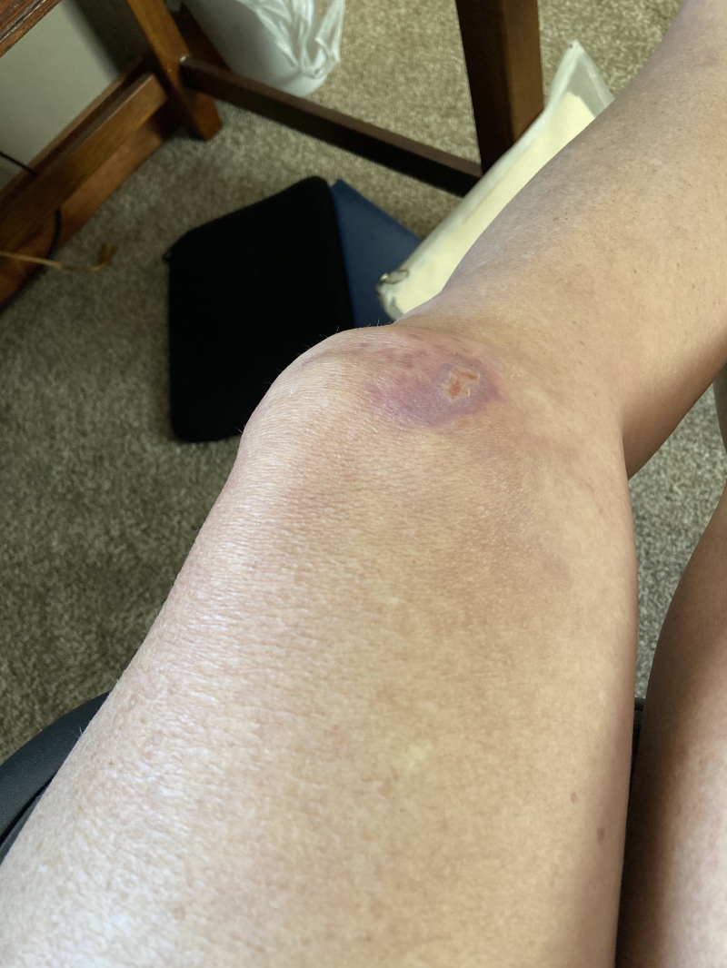 2022/06(June)/Suzi-Broken-Arm/800x600_2022-07-11-Suzi-Broken-Arm-scraped-knee-24.JPG