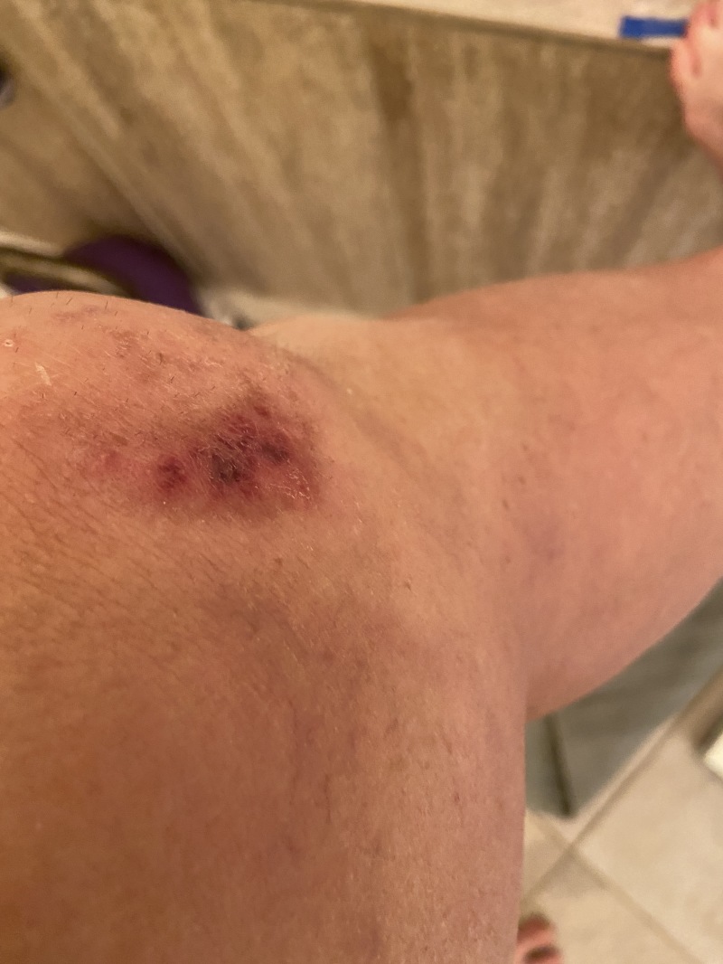 2022/06(June)/Suzi-Broken-Arm/800x600_2022-09-05-Suzi-Broken-Arm-scraped-knee-25.JPG