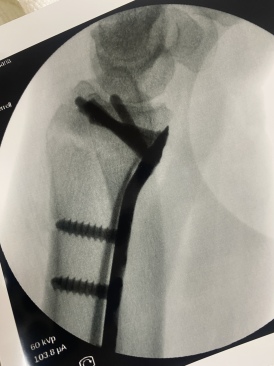 2022-06-15-Suzi-Broken-Arm-scraped-knee-11.JPG