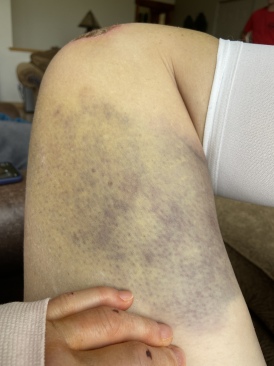 2022-06-18-Suzi-Broken-Arm-scraped-knee-13.JPG