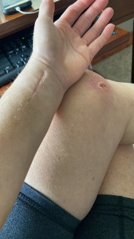 2022-07-08-Suzi-Broken-Arm-scraped-knee-23.JPG