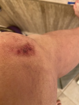 2022-09-05-Suzi-Broken-Arm-scraped-knee-25.JPG