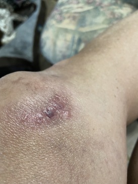 2022-09-11-Suzi-Broken-Arm-scraped-knee-27.JPG