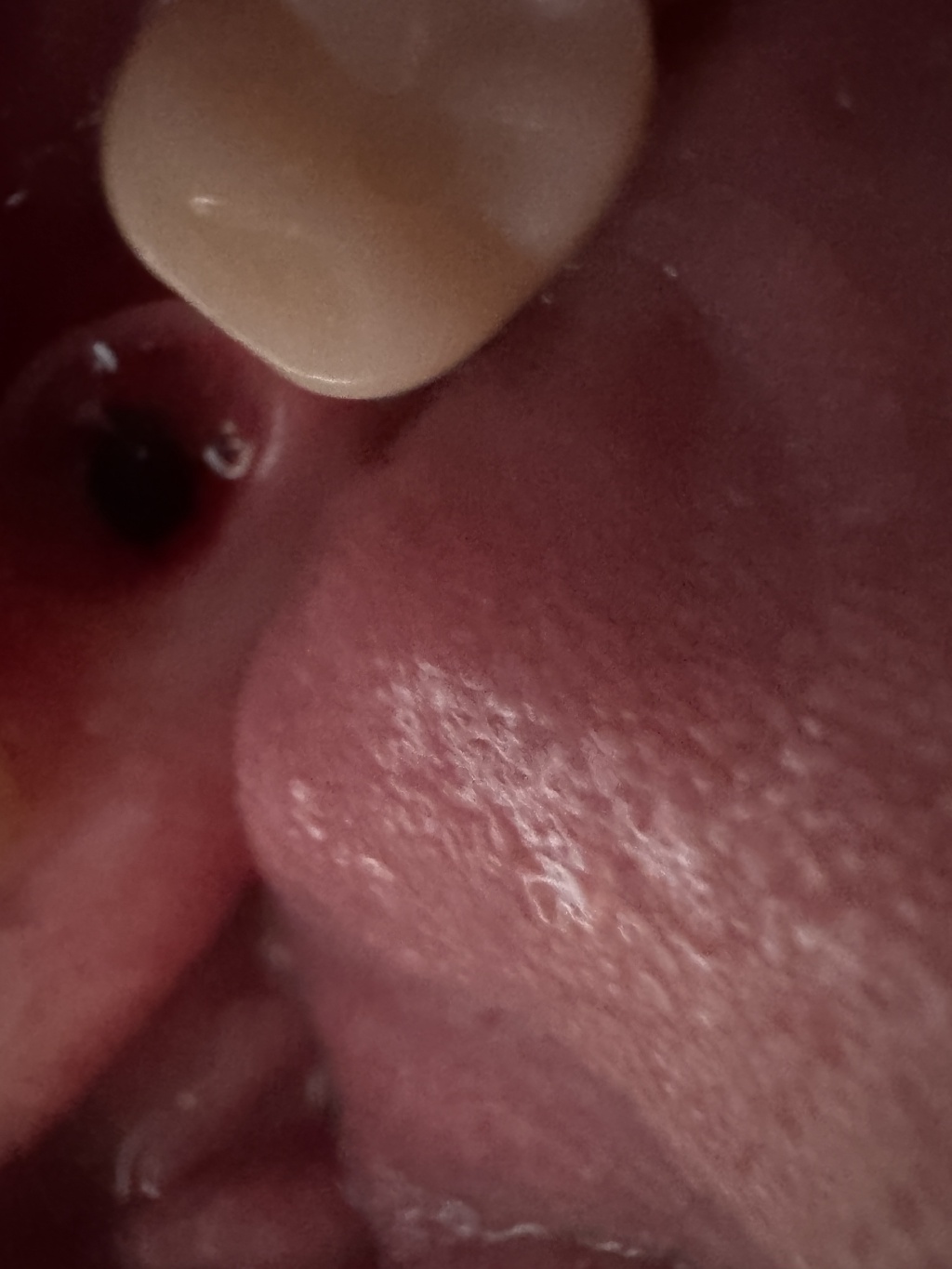 2024/01(January)/Misc/1024x768_2024-11-19-Travis-Implant-Lower-Right-2.JPG