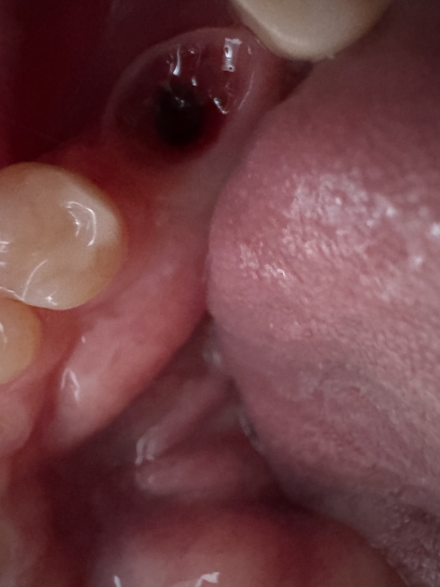 2024/01(January)/Misc/640x480_2024-11-19-Travis-Implant-Lower-Right-3.JPG