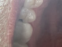 2024-06-07-Travis-Chipped-Tooth-1.JPG