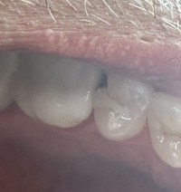 2024-06-07-Travis-Chipped-Tooth-2.JPG