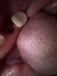 2024-11-19-Travis-Implant-Lower-Right-1.JPG