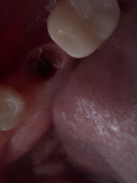 2024-11-19-Travis-Implant-Lower-Right-4.JPG