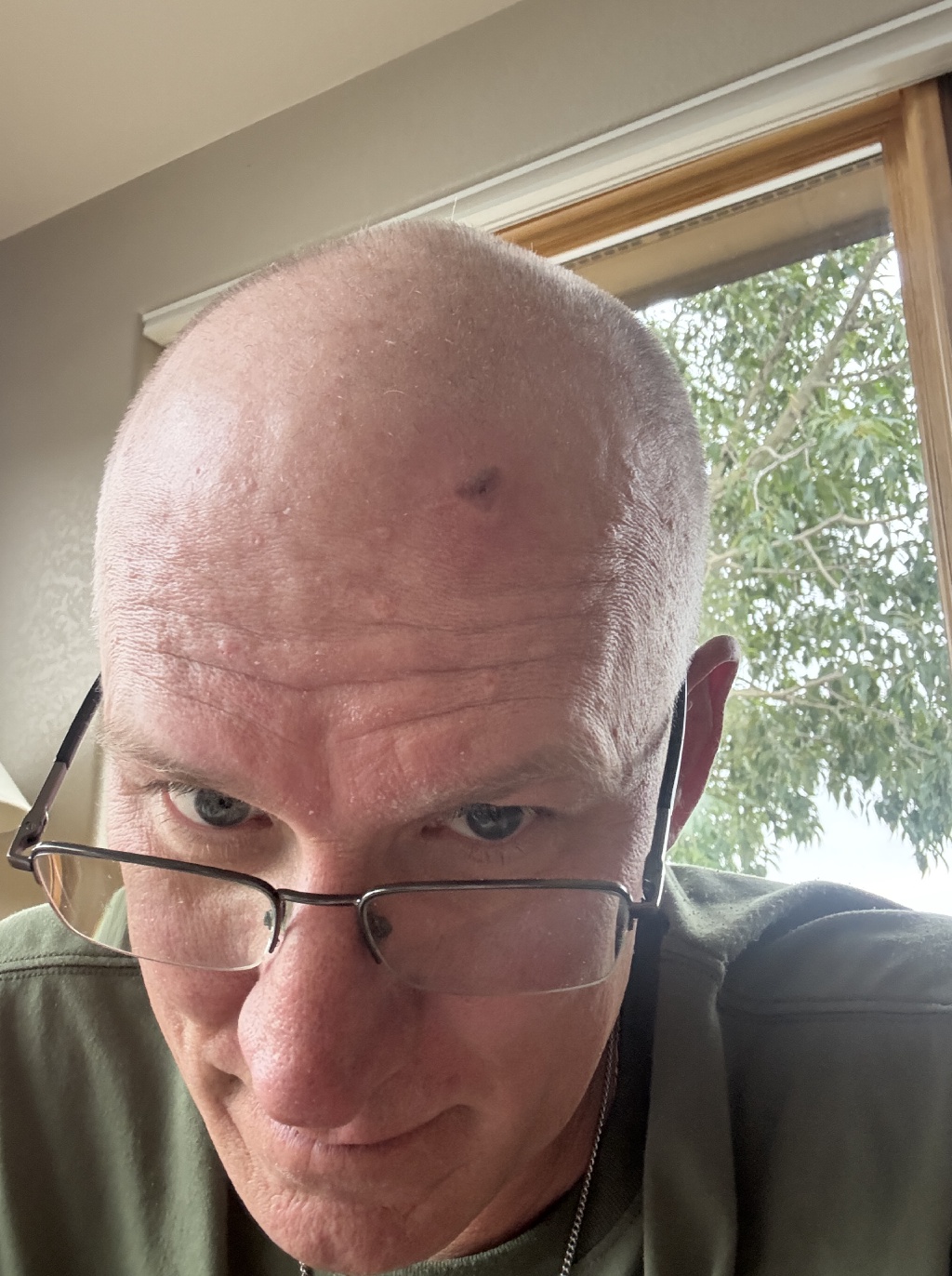 2025/08(August)/Travis-Dermatology-Mole-Freeze/2025-07-21-Travis-Mole-freeze-1.JPG
