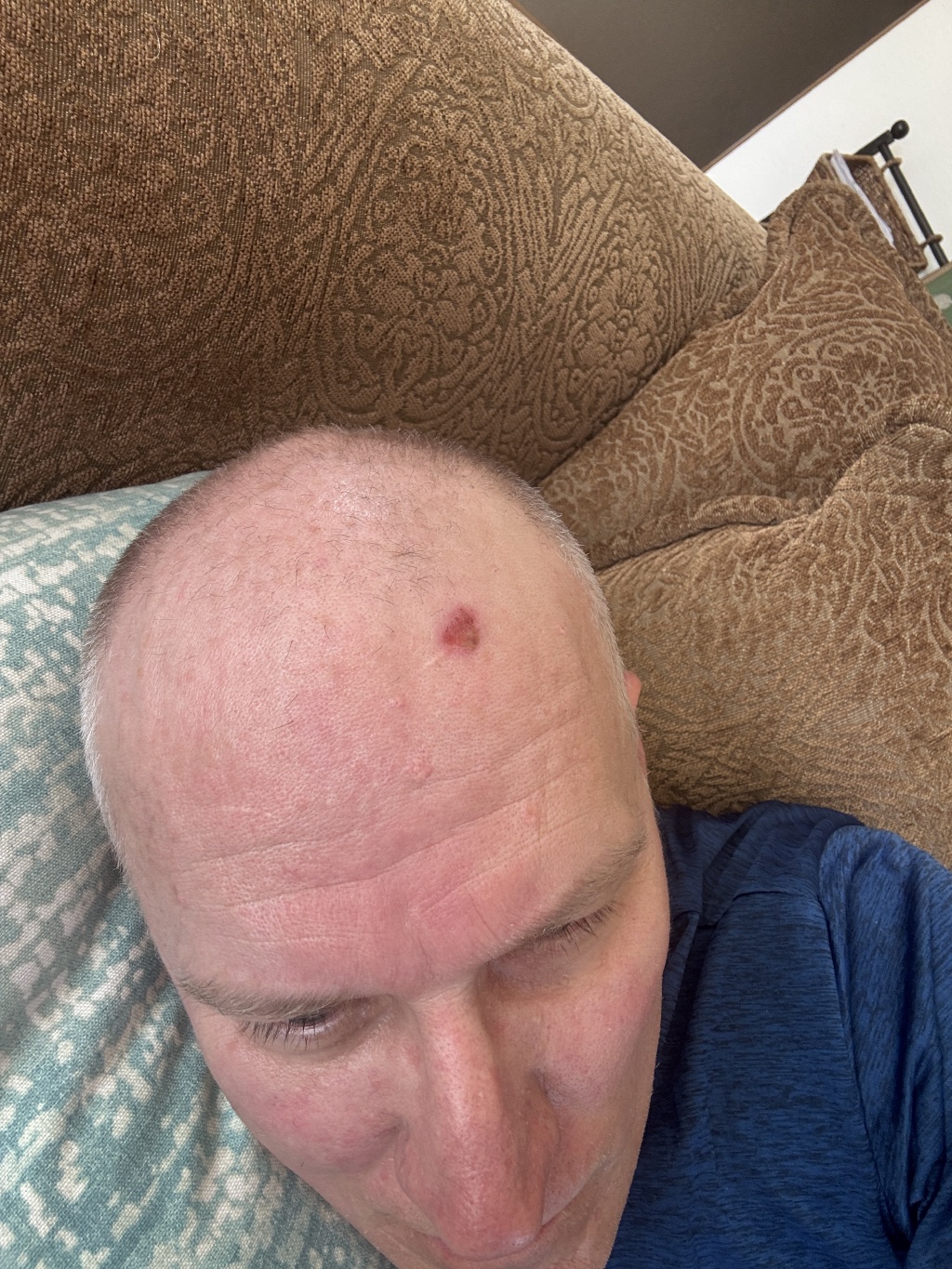 2025/08(August)/Travis-Dermatology-Mole-Freeze/1024x768_2025-07-27-Travis-Mole-freeze-5.JPG