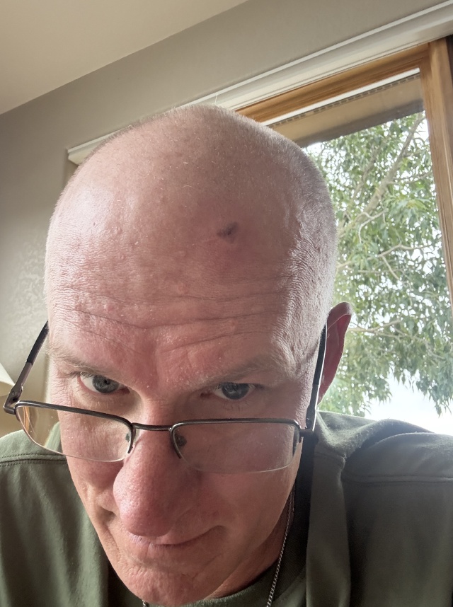 2025/08(August)/Travis-Dermatology-Mole-Freeze/2025-07-21-Travis-Mole-freeze-1.JPG