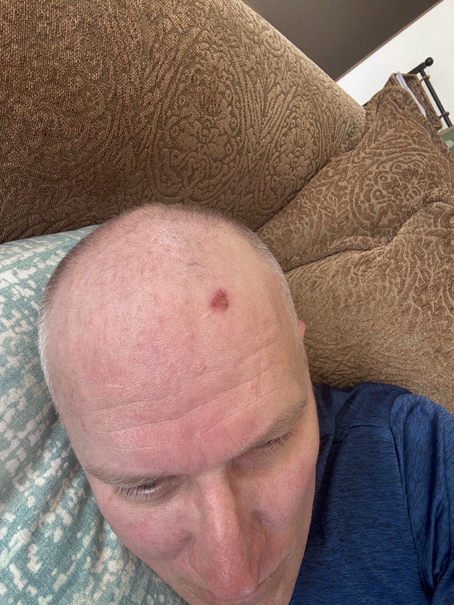 2025/08(August)/Travis-Dermatology-Mole-Freeze/640x480_2025-07-27-Travis-Mole-freeze-5.JPG
